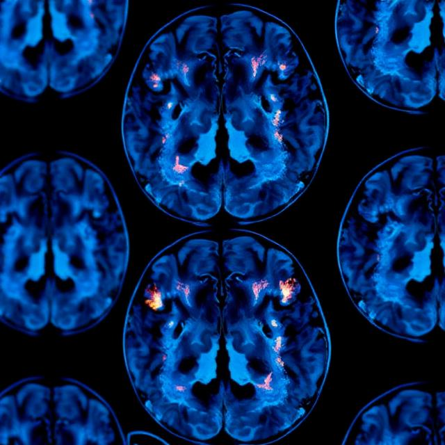 Acumen Pharmaceuticals Poised for Breakthroughs in Alzheimer's Treatment