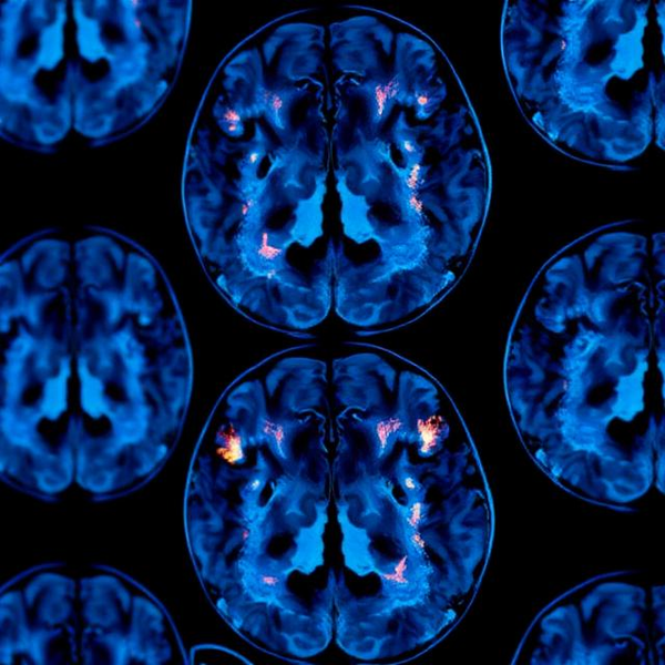 Acumen Pharmaceuticals Poised for Breakthroughs in Alzheimer's Treatment